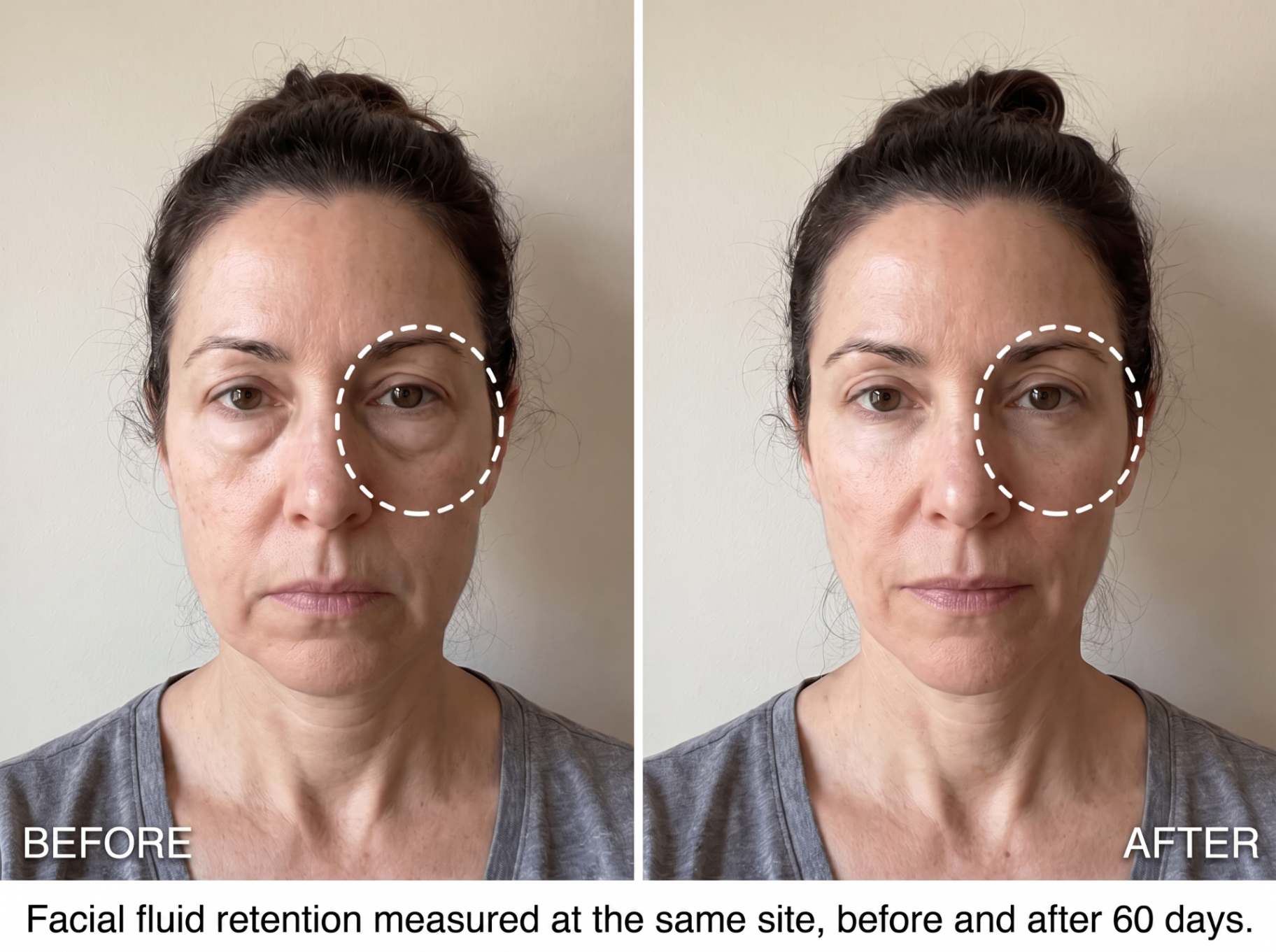 Lisa before and after 60 days — facial fluid retention measured at the same site