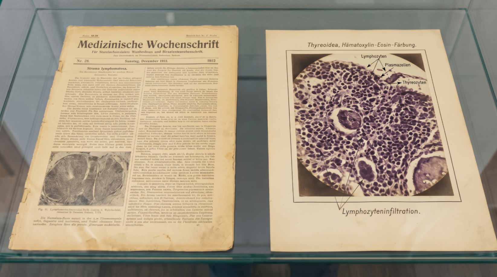 Historic 1912 medical journal beside a microscope slide showing lymphocytic infiltration